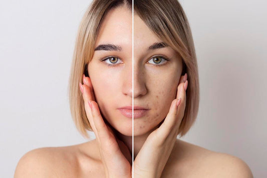 Dévoiler la Vérité sur l'Hyperpigmentation : Causes, Raisons et Solutions Éclairantes avec MOONLINE Cosmetics